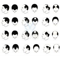 【Ebpay基因检测】过早<font color='red'>脱发</font>、掉发太多怎么办？你的方法可能是错的！
